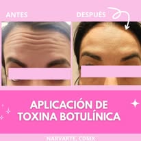 Tratamiento de toxina botulínica antes y después